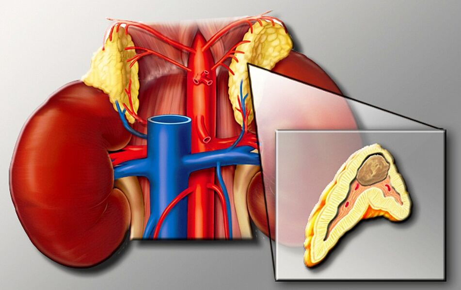 Pheochromocytoma for hypertension